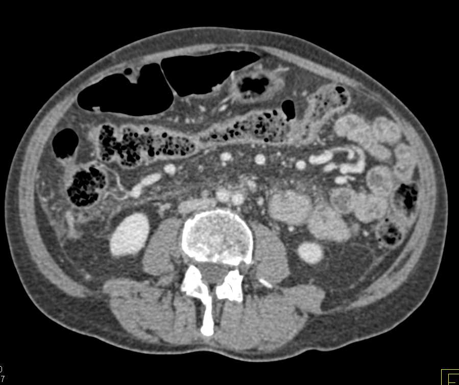 Pancreatic Cancer with Superior Mesenteric Artery (SMA) Encasement and Liver Metastases - CTisus CT Scan