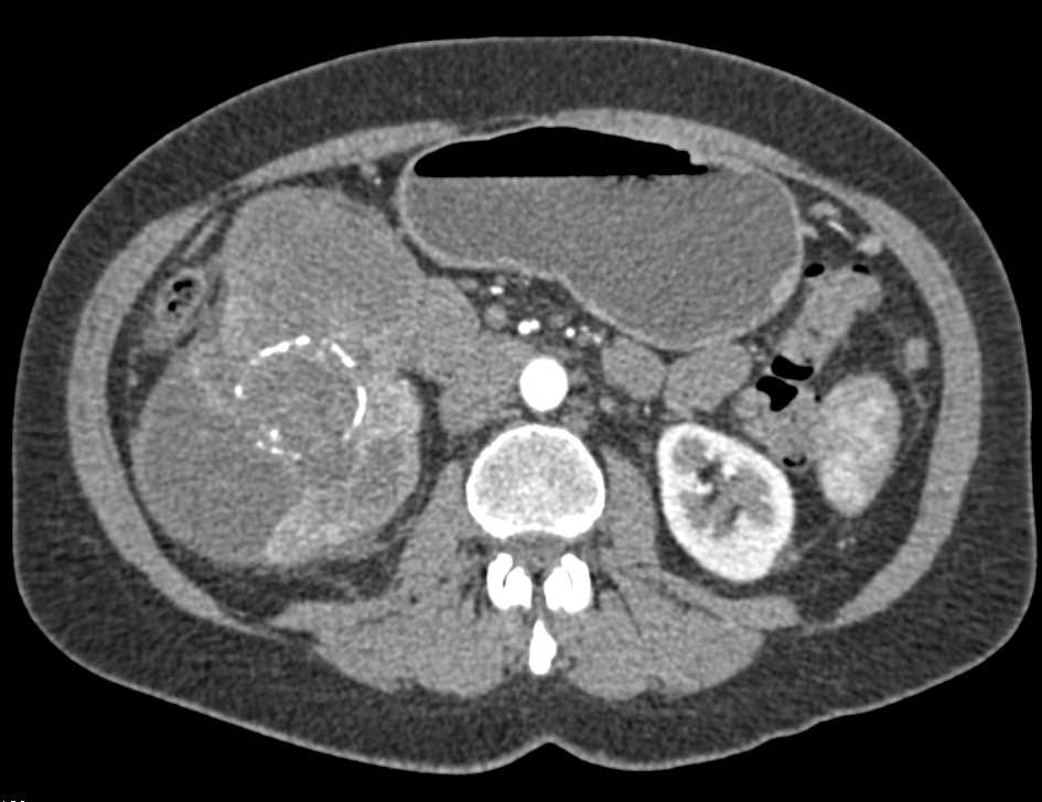 Pancreatic Abscess in a Patient with Incidental Renal Cell Carcinoma - CTisus CT Scan