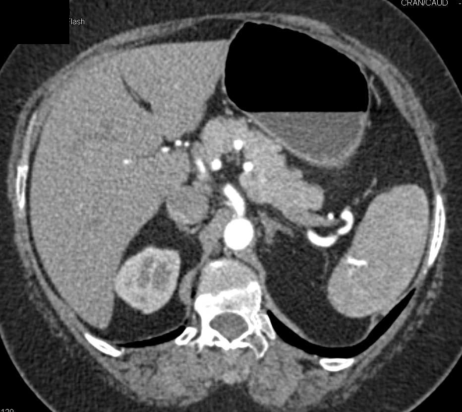 Focal Fat in Body of Pancreas Simulates a Cystic Lesion - CTisus CT Scan