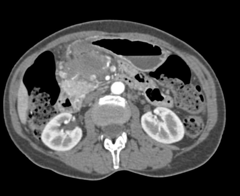 Necrotic Carcinoma of the Pancreatic Head - CTisus CT Scan