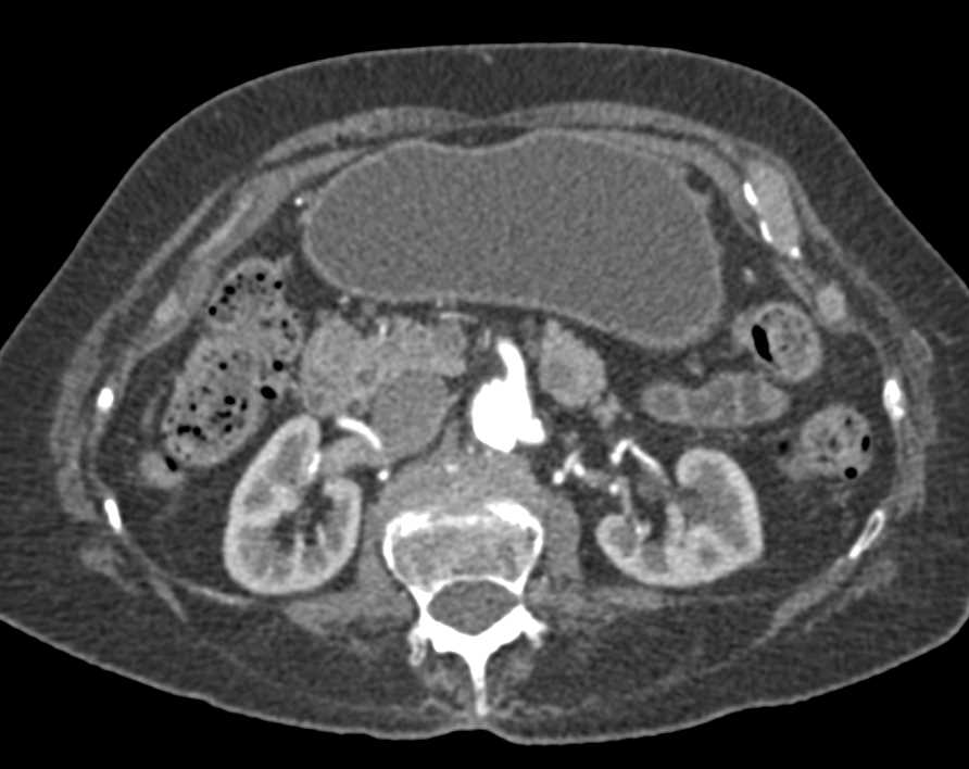 Incidental Pancreatic Cancer - CTisus CT Scan