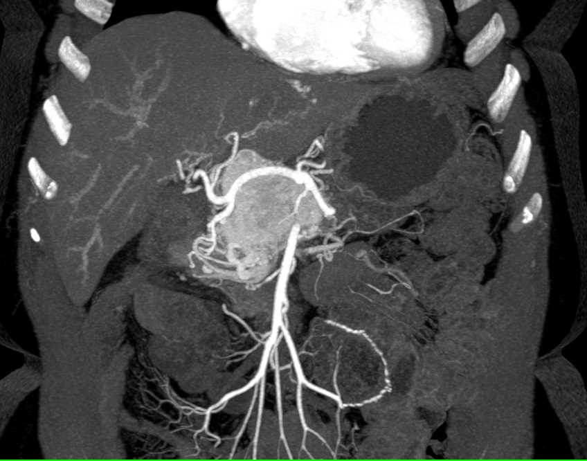 Neuroendocrine Tumor in the Head of the Pancreas - CTisus CT Scan