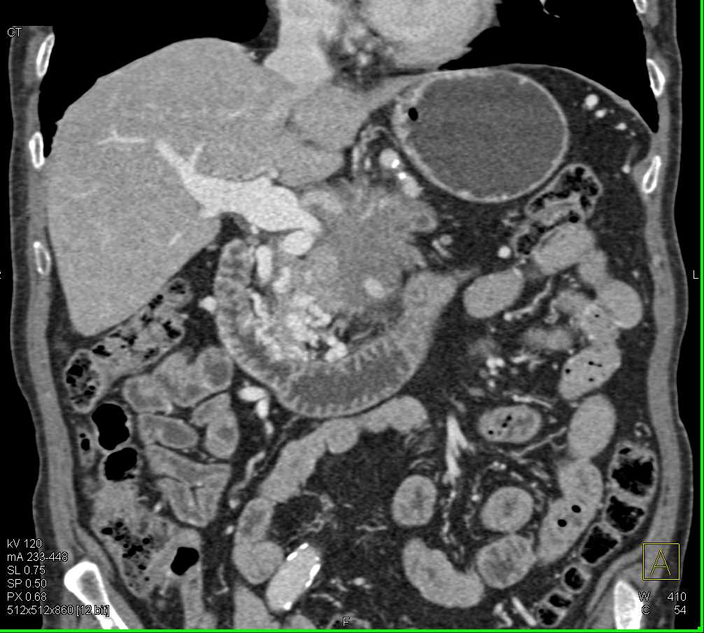 Pancreatic Adenocarcinoma with Arterial and Venous Encasement - CTisus CT Scan