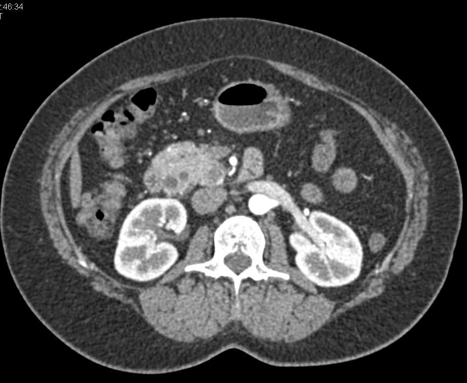 Ampullary Carcinoma with Local Spread - CTisus CT Scan