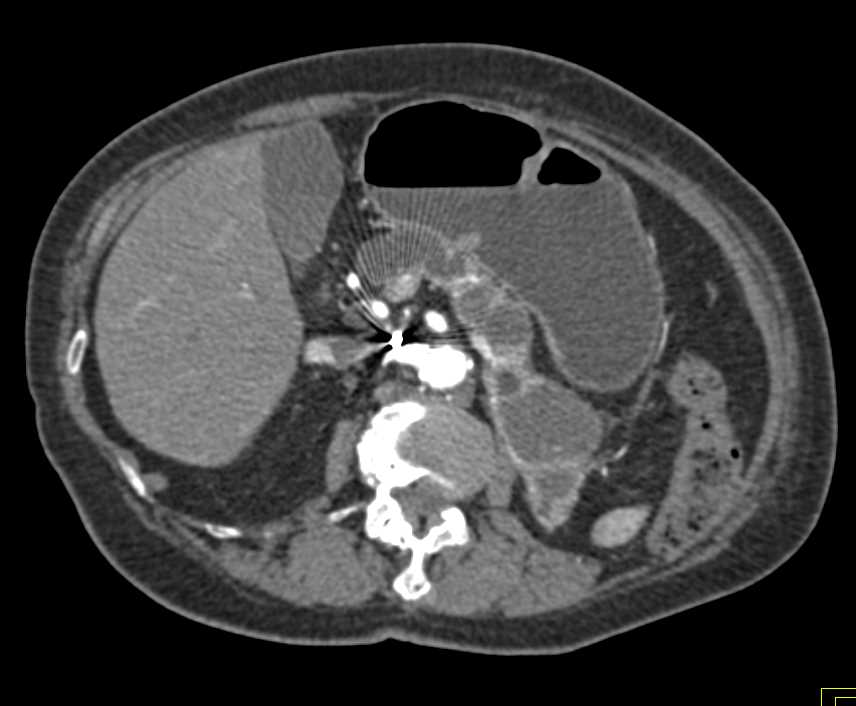 Multiple Intraductal Papillary Mucinous Neoplasms (IPMNs) in a Patient with a Prior Left Nephrectomy - CTisus CT Scan