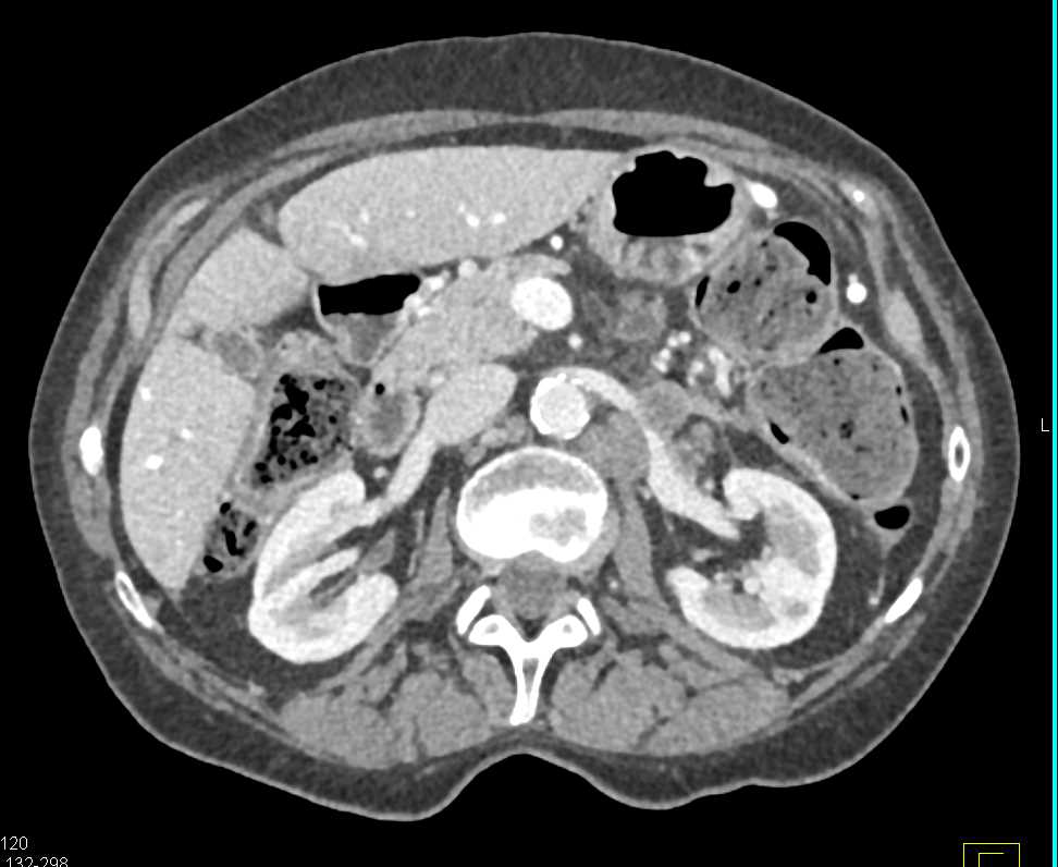 Carcinoma Tail of Pancreas with Para-aortic Adenopathy - CTisus CT Scan