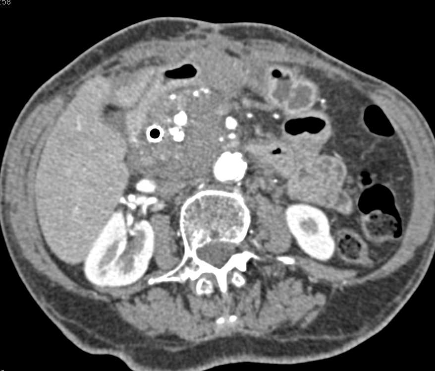 Pancreatic Adenocarcinoma with Local Spread - CTisus CT Scan