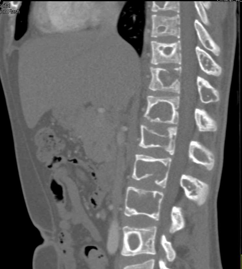 Intraductal Papillary Mucinous Neoplasm (IPMN) in Patient with Fibrous Dysplasia - CTisus CT Scan