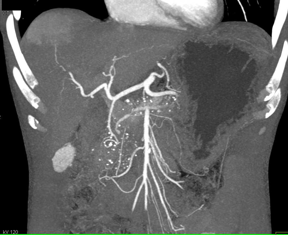 Chronic Pancreatitis - CTisus CT Scan