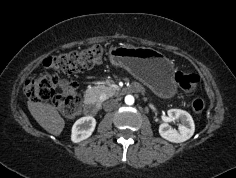 Subtle Neuroendocrine Tumor in Head of the Pancreas - CTisus CT Scan