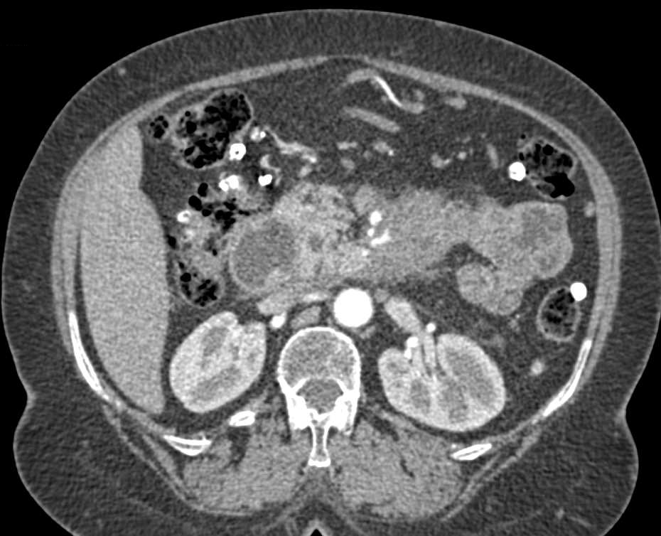 Carcinoma Tail of the Pancreas - CTisus CT Scan