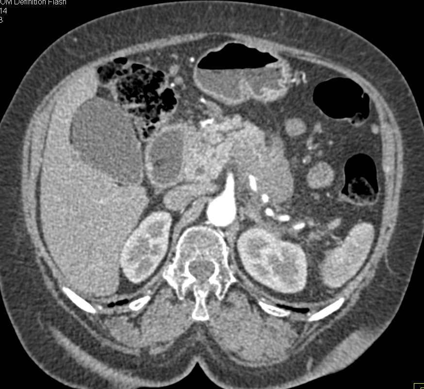 Pancreatic Adenocarcinoma Tail of Pancreas Invades the Duodenum - CTisus CT Scan