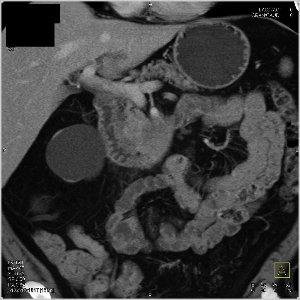 Pancreatic Adenocarcinoma  Invades the Duodenum - CTisus CT Scan