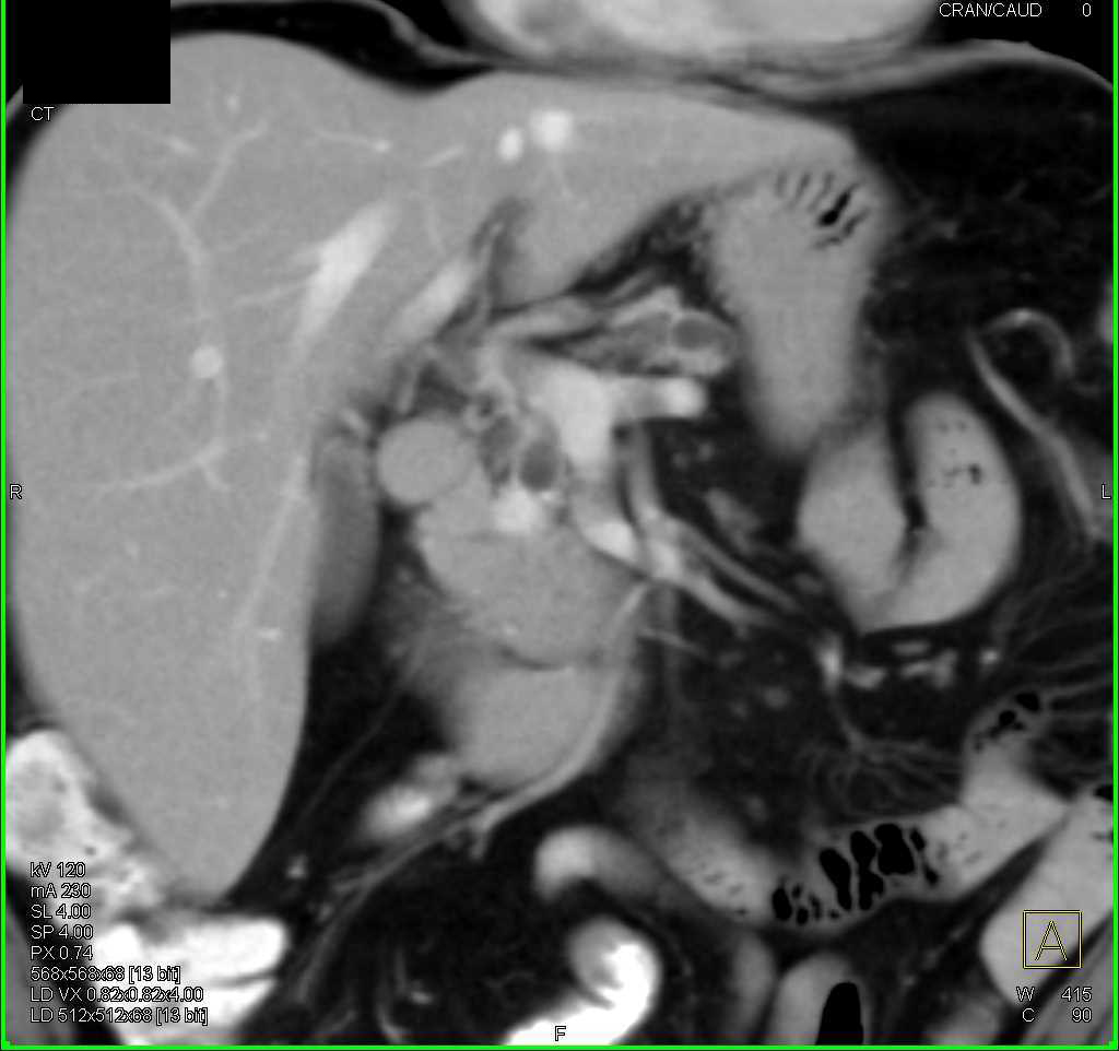 Neuroendocrine Tumor Head of Pancreas - CTisus CT Scan