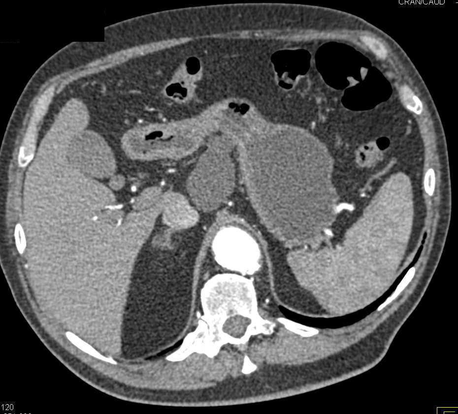 Lymphoepithelial Cyst Pancreas Simulates a Duplication Cyst Stomach - CTisus CT Scan