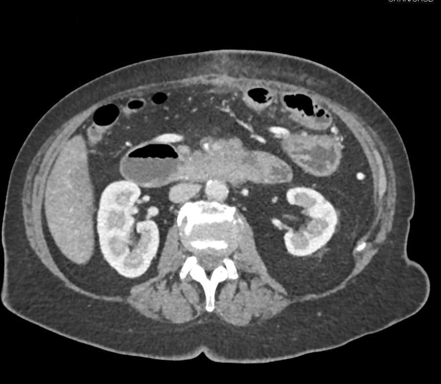 Pancreatic Adenocarcinoma  Invades the Duodenum and Mesenteric Vessels - CTisus CT Scan