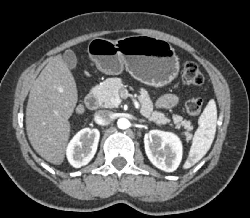 Subtle 1cm Neuroendocrine Tumor in the Head of the Pancreas - CTisus CT Scan