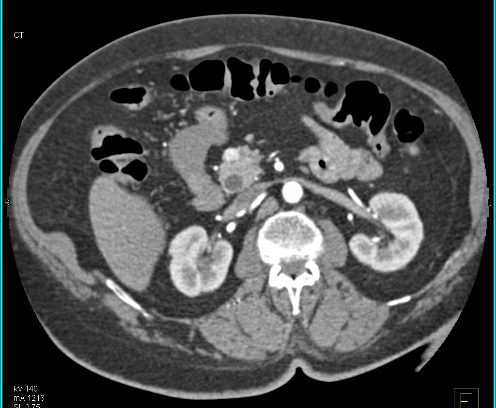 1cm Neuroendocrine Tumor in the Head of the Pancreas - CTisus CT Scan