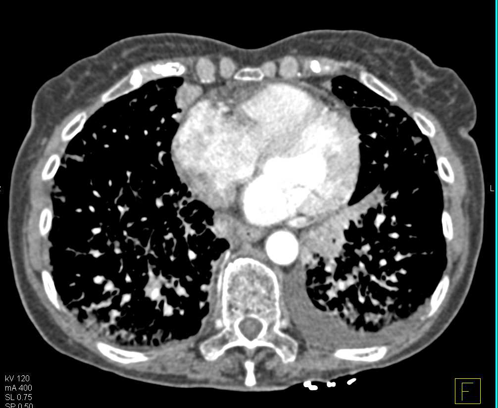 SPEN Tumor Tail of the Pancreas - CTisus CT Scan