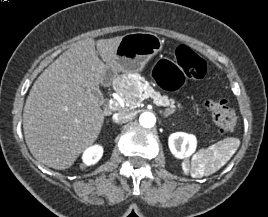 Neuroendocrine Tumor Head of Pancreas - CTisus CT Scan