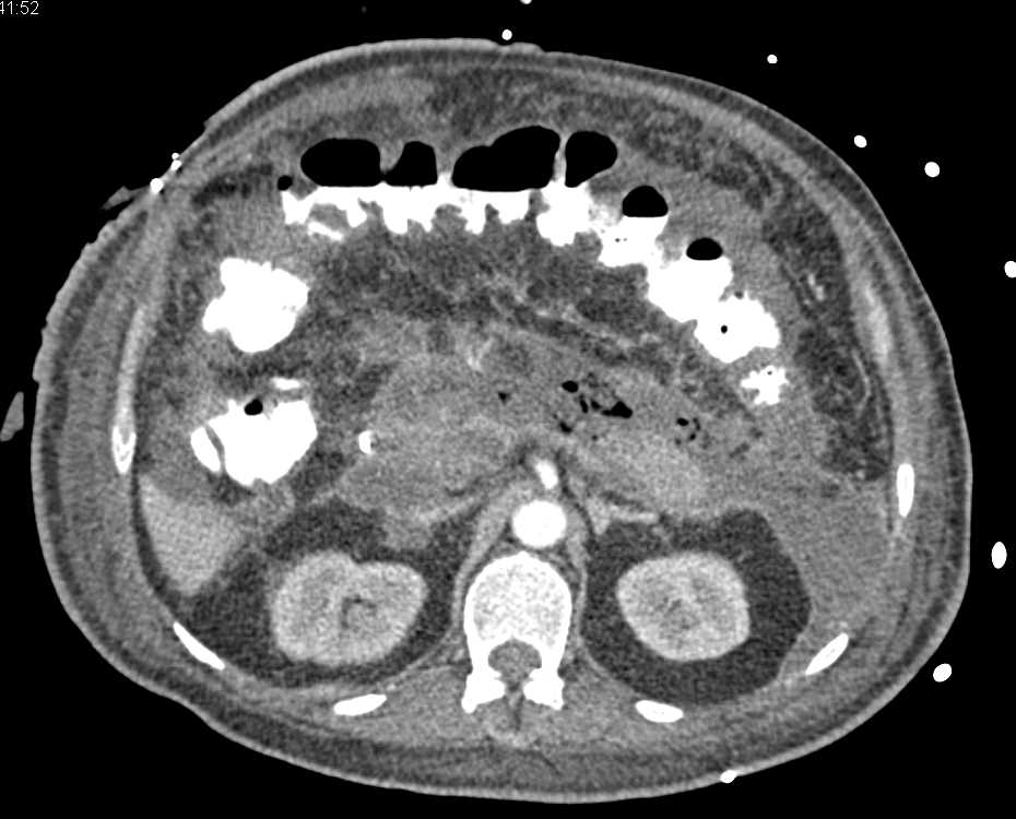 Necrotizing Pancreatitis with Drain in Place - CTisus CT Scan