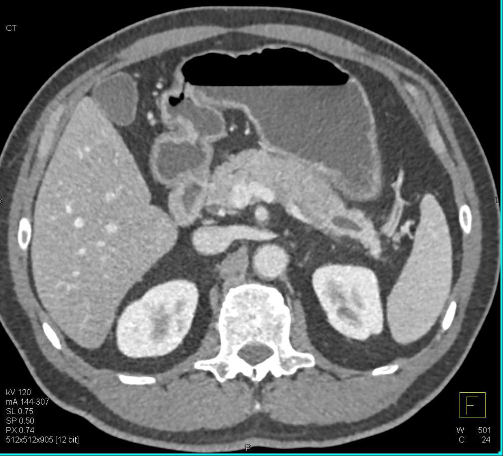 Subtle Carcinoma of the Body of the Pancreas with Dilated Pancreatic Duct - CTisus CT Scan