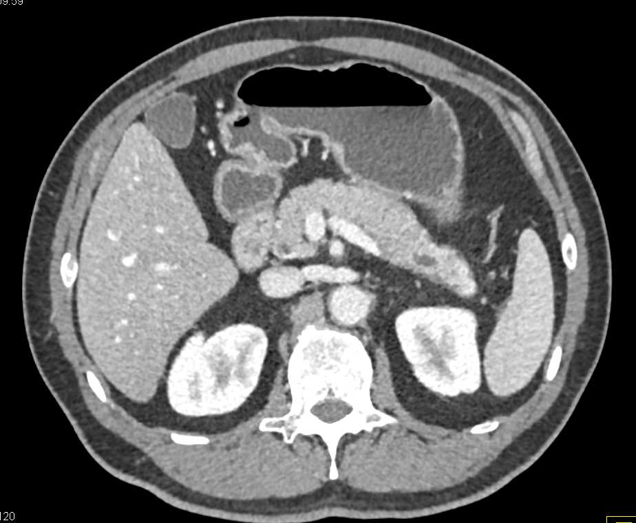 Subtle Carcinoma of the Body of the Pancreas with Dilated Pancreatic Duct - CTisus CT Scan