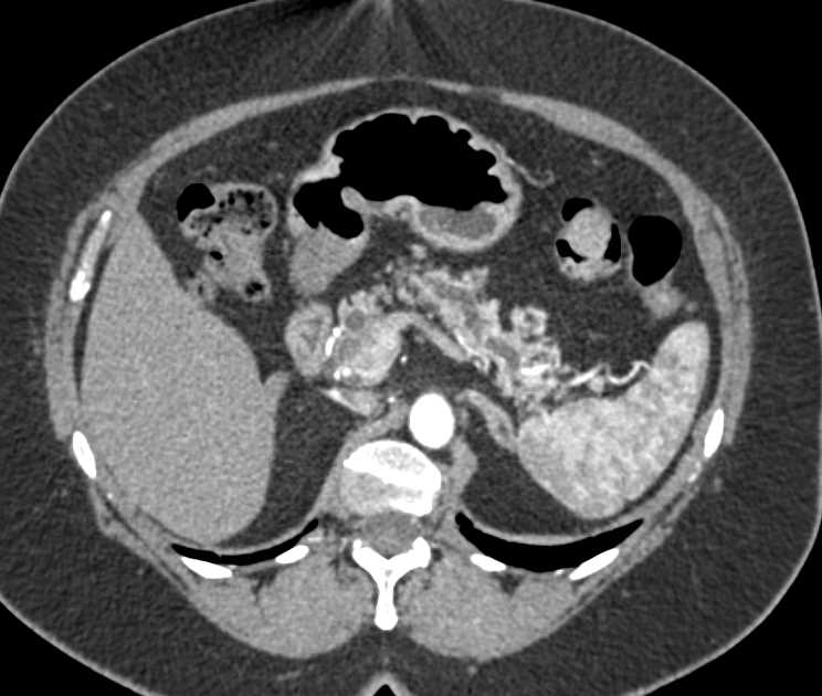 Neuroendocrine Tumor in the Head of the Pancreas - CTisus CT Scan