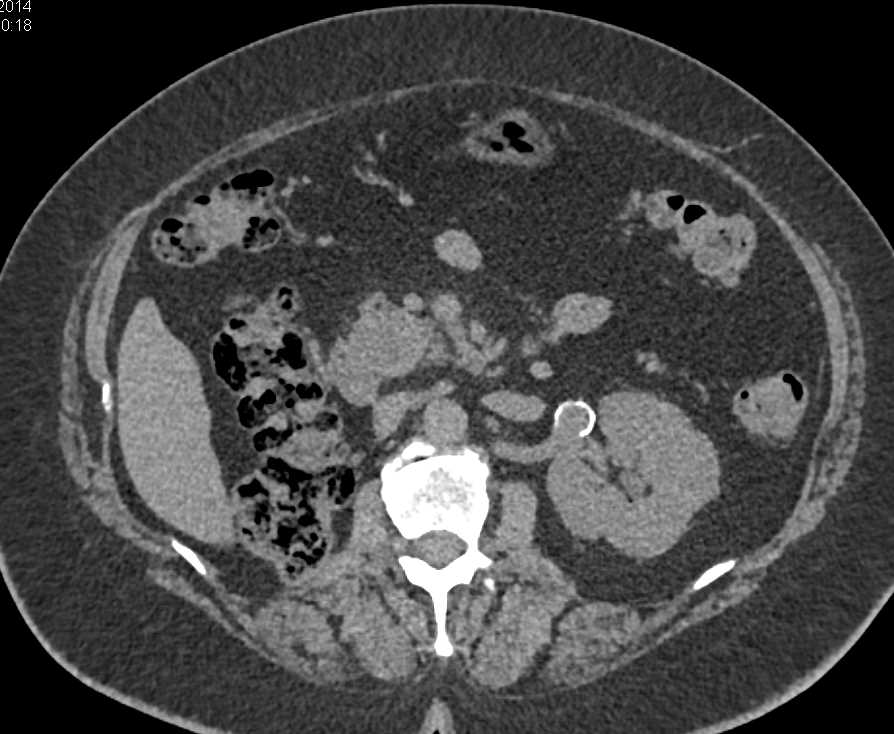 Recurrent Renal Cell Carcinoma Metastatic to the Pancreas - CTisus CT Scan