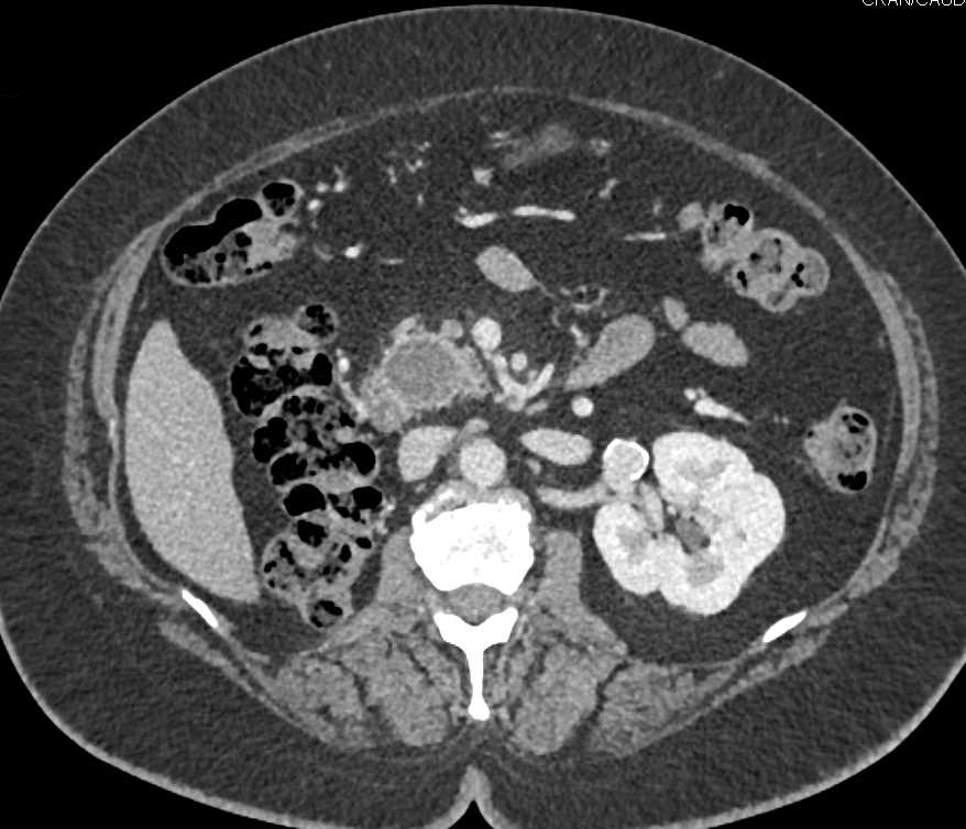 Recurrent Renal Cell Carcinoma Metastatic to the Pancreas, Contralateral Adrenal and Adenopathy - CTisus CT Scan