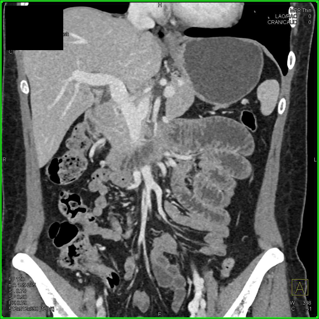 Pancreatic Cancer Encases the PV/SMV Junction - CTisus CT Scan