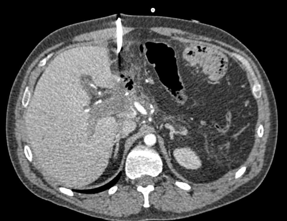 Portal Vein and SV Clot s/p Whipple Procedure - CTisus CT Scan