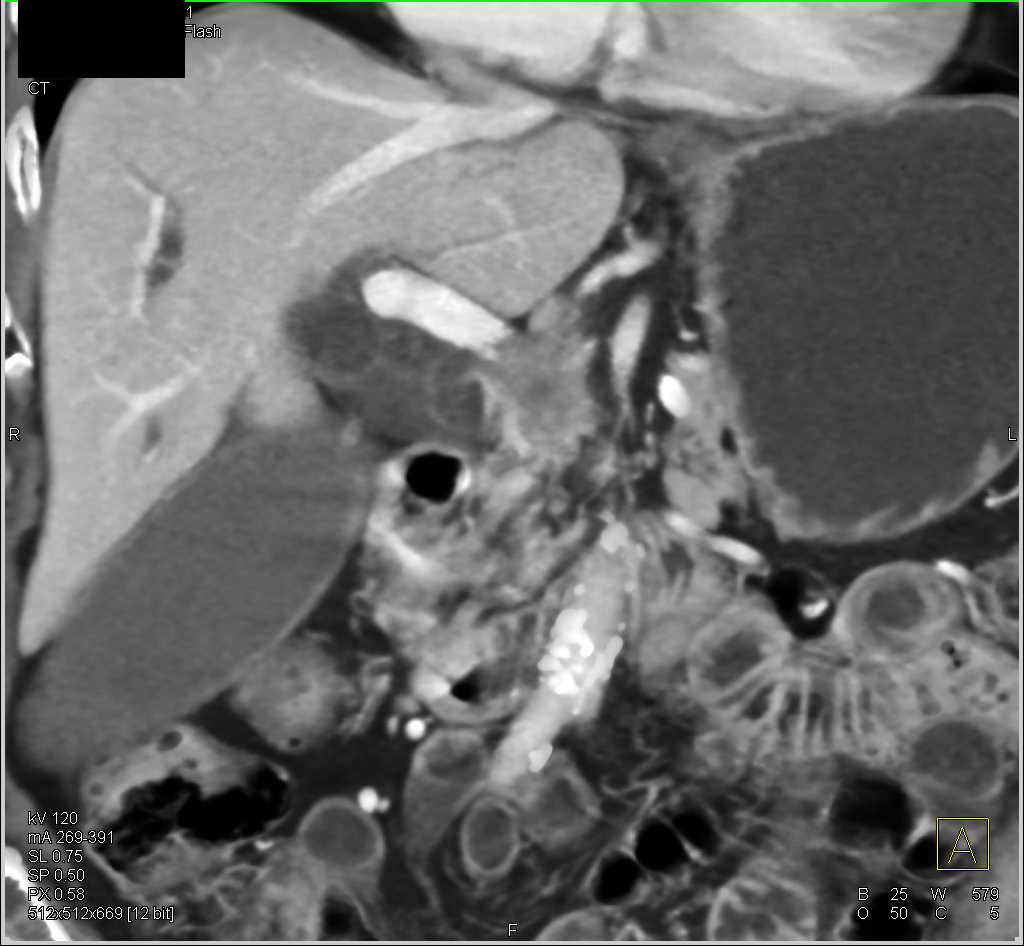 Carcinoma of the Head of the Pancreas - CTisus CT Scan