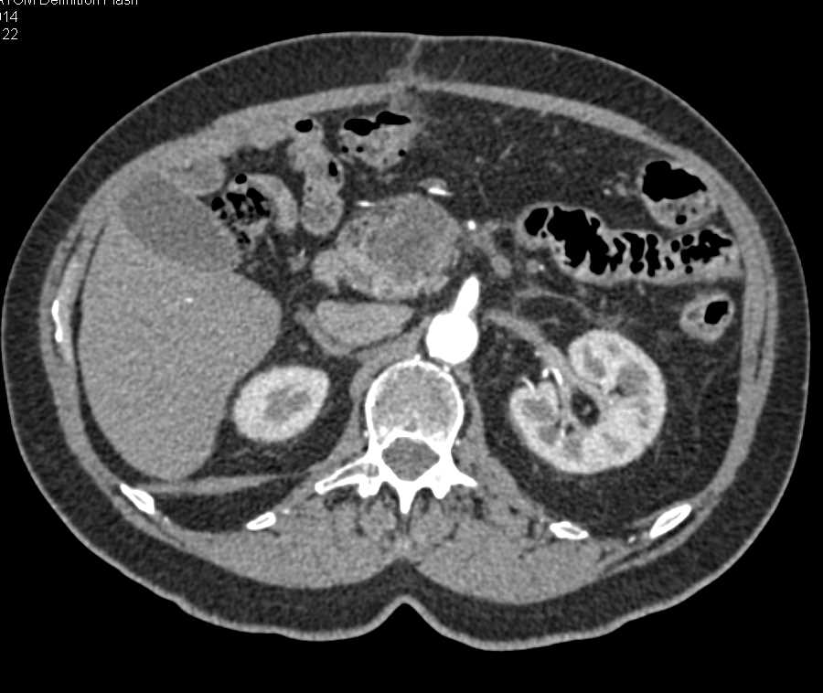 Pancreatic Adenocarcinoma with Liver Metastases - CTisus CT Scan