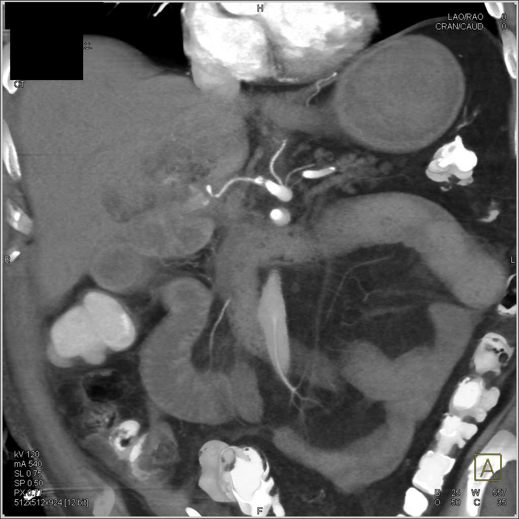 Gastroduodenal Artery (GDA) Pseudoaneurysm Following Whipple Procedure with Active Bleed - CTisus CT Scan