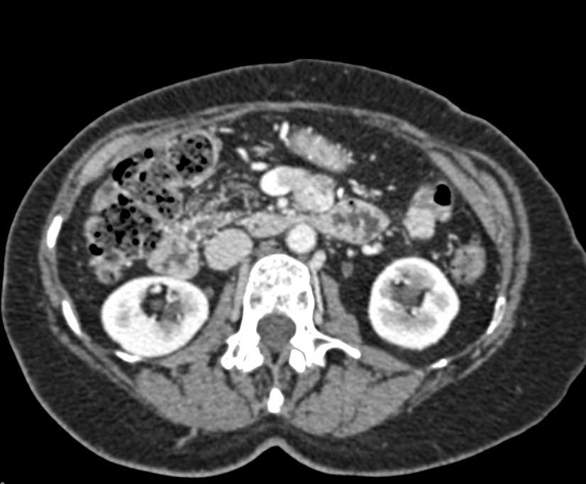 Recurrent Neuroendocrine Tumor Invades the Superior Mesenteric Vein (SMV) - CTisus CT Scan