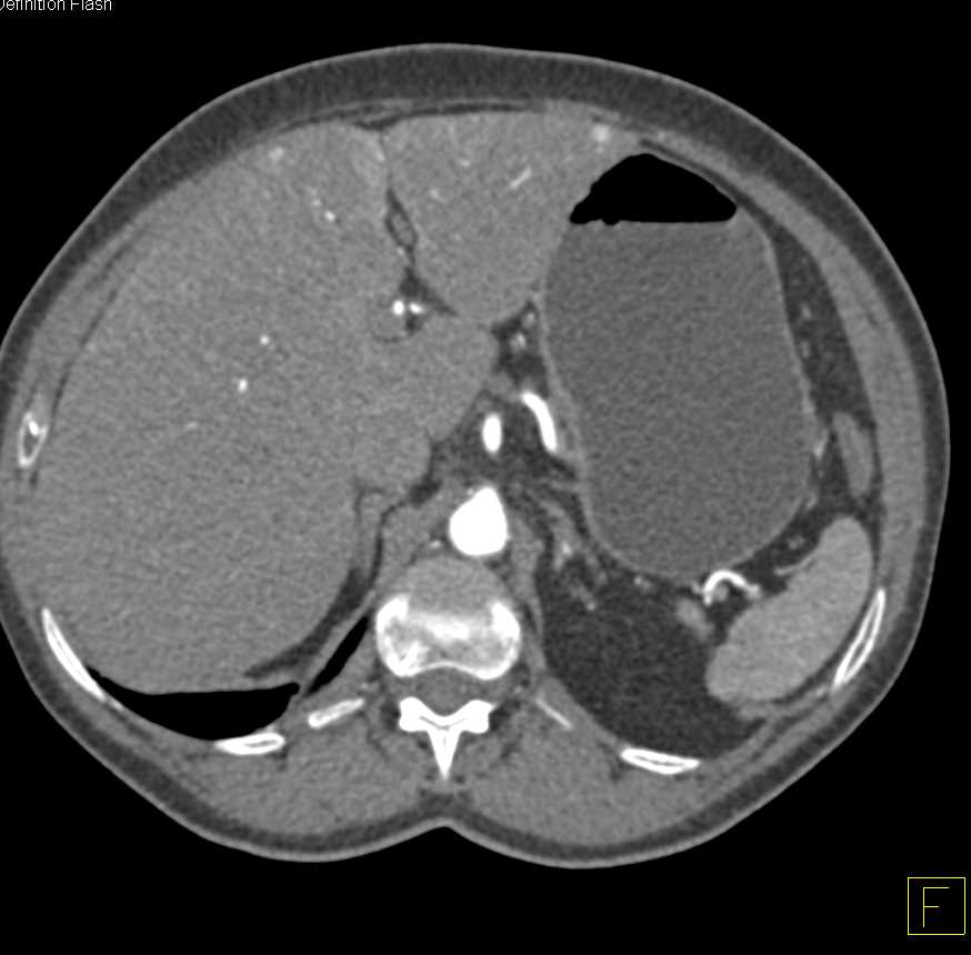 Intraductal Papillary Mucinous Neoplasm (IPMN) in Head of Pancreas with Small Arteriovenous (AV) Shunts Liver - CTisus CT Scan