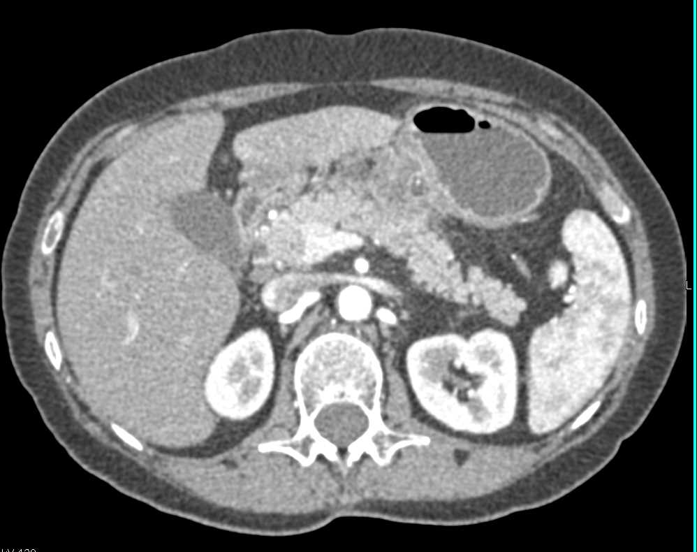 Acute Pancreatitis Over Time - CTisus CT Scan