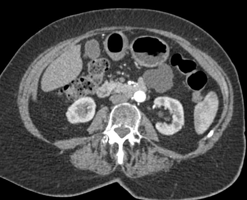 Pancreatic Lymphangioma - CTisus CT Scan