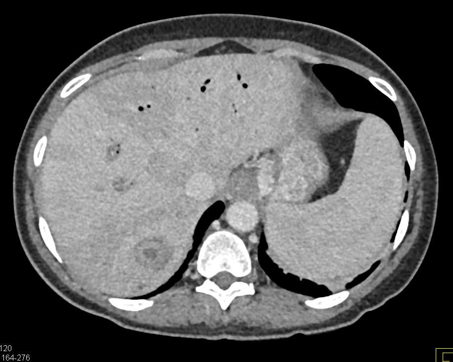 Post Whipple Patient with Liver Abscess and Colitis - CTisus CT Scan