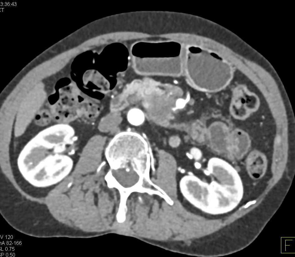 Adenocarcinoma of the Head of the Pancreas - CTisus CT Scan