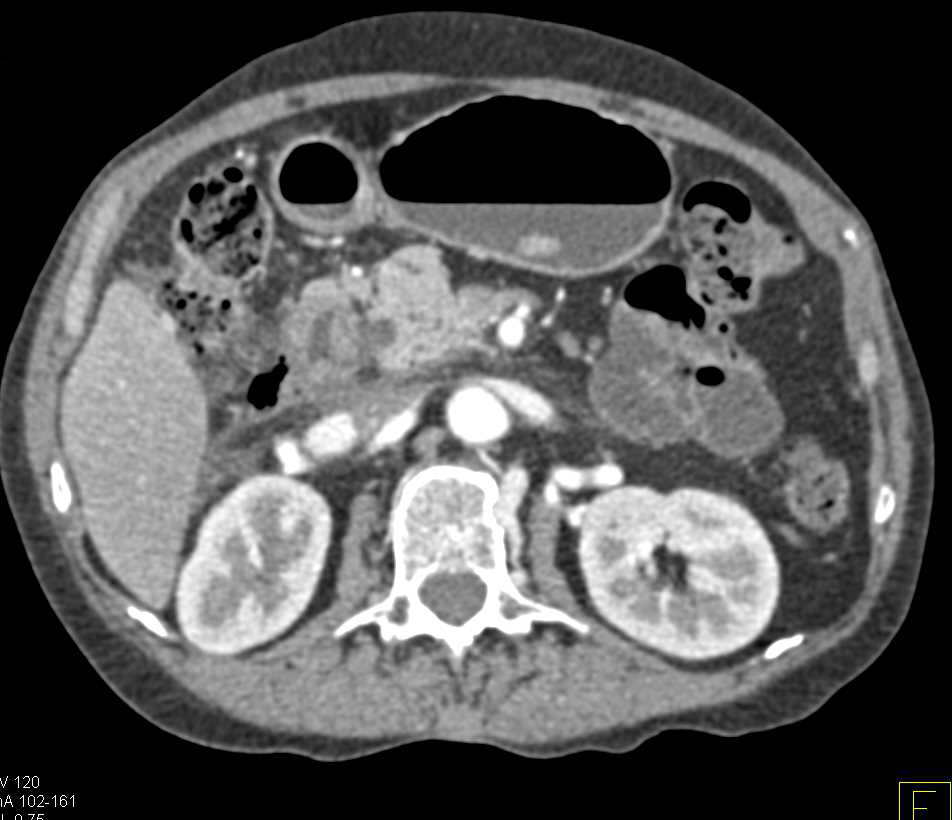 Carcinoma of the Head of the Pancreas - CTisus CT Scan