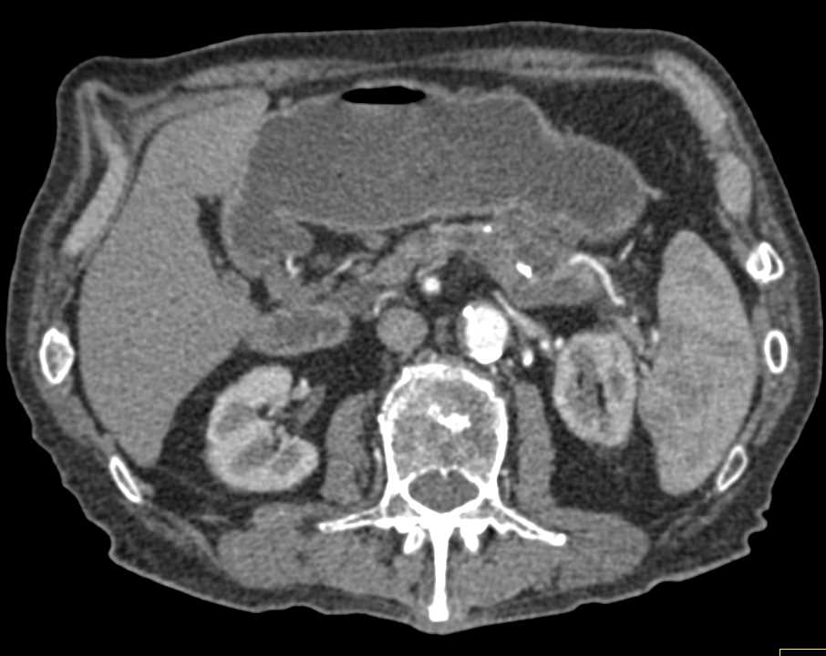 Carcinoma of the Tail of the Pancreas with Vascular Involvement - CTisus CT Scan