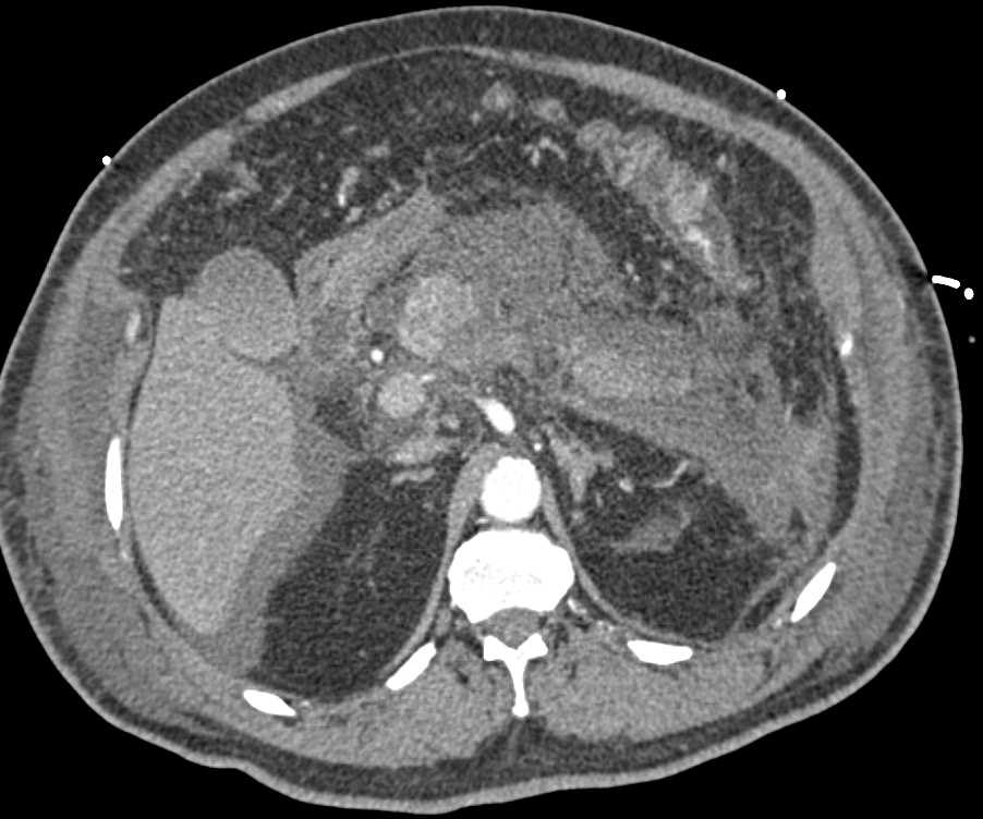 Acute Pancreatitis - CTisus CT Scan