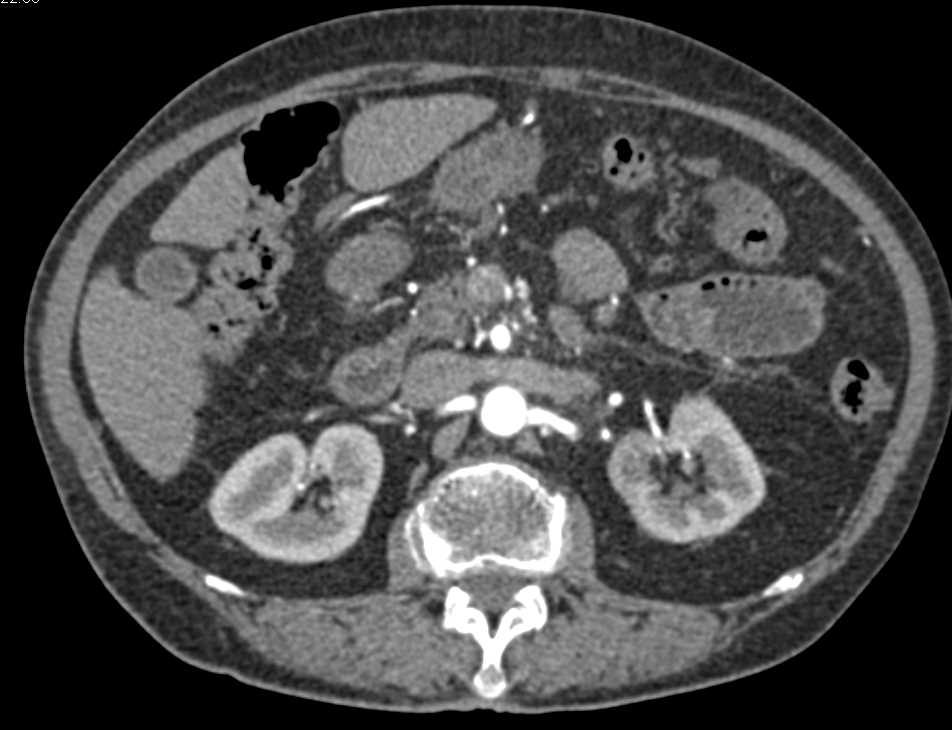 Neuroendocrine Tumor of the Pancreas - CTisus CT Scan