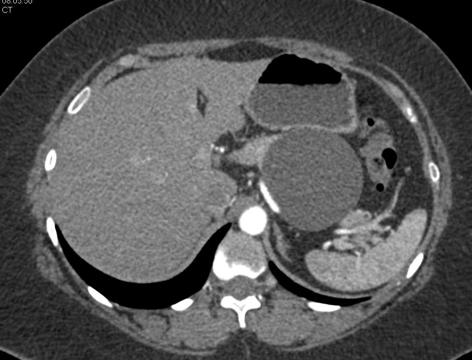 Serous Cystadenoma Tail of Pancreas - CTisus CT Scan