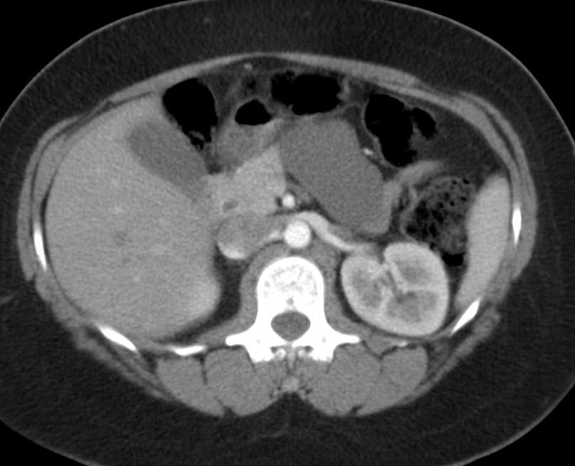 Serous Cystadenoma Tail of Pancreas - CTisus CT Scan