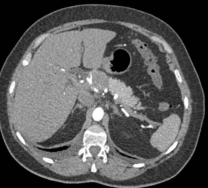 Pancreatic Adenocarcinoma - CTisus CT Scan