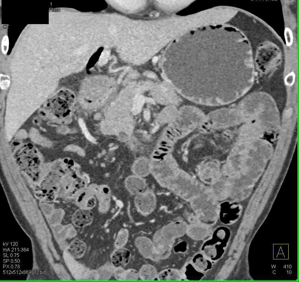 Pancreatic Adenocarcinoma and Incidental Angiomyolipoma (AML) Lower Pole Left Kidney - CTisus CT Scan