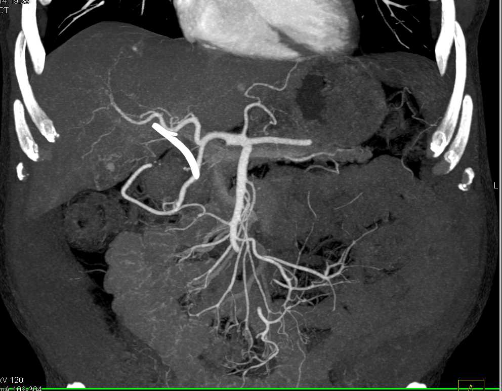 Pancreatic Cancer Invades the Duodenum - CTisus CT Scan